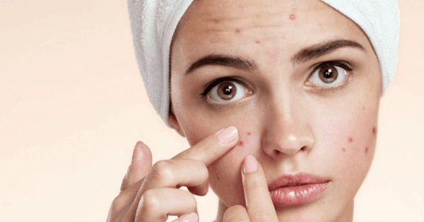 Πότε τα σπυράκια οφείλονται σε μυκητα; Πως να το καταλάβετε και τι να κάνετε