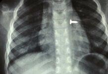 Χειρουργοί στην Κρήτη μετά από πολύωρη επέμβαση αφαίρεσαν μια βίδα από τους πνεύμονες ενός 3χρονου κοριτσιού.