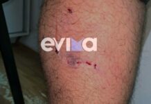 Αδέσποτα σκυλιά δάγκωσαν 21χρονο στην Ερέτρια