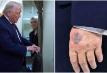 Η εξήγηση για τη νέα τεράστια μελανιά στο χέρι του Τραμπ – «Είναι παρενέργεια»